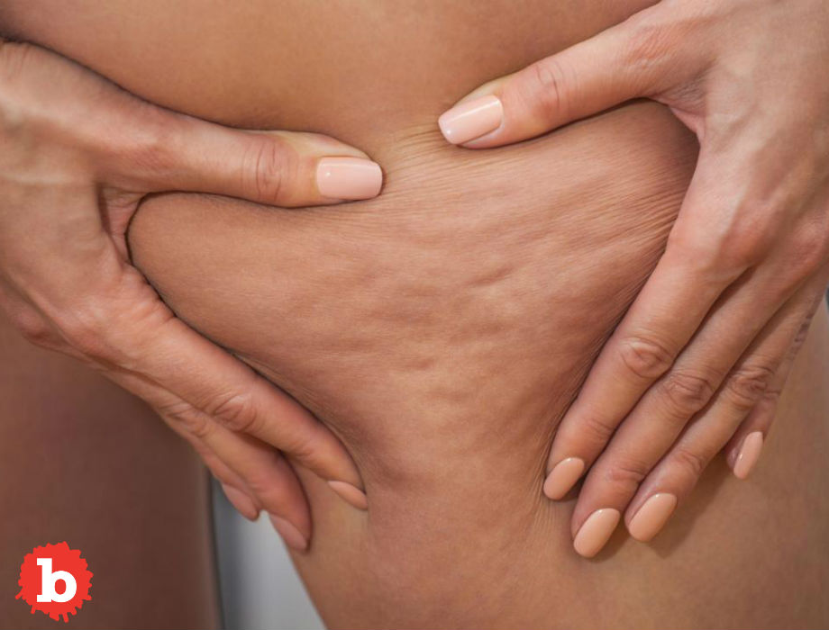 4 Simple and Proven Ways Prevent Cellulite