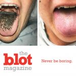 Antibiotics Give Missouri Woman Hairy Black Tongue