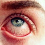 Scottish Woman Given Erectile Dysfunction Cream for Eyes