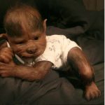 17 Babies in Spain Get Werewolf Syndrome After Drug Error
