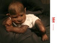 17 Babies in Spain Get Werewolf Syndrome After Drug Error