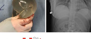 Breast Implants Save Woman’s Life From Bullet Aimed at Heart