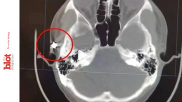 20 Years With Air Gun Pellet in Head Caused Man’s Chronic Headaches
