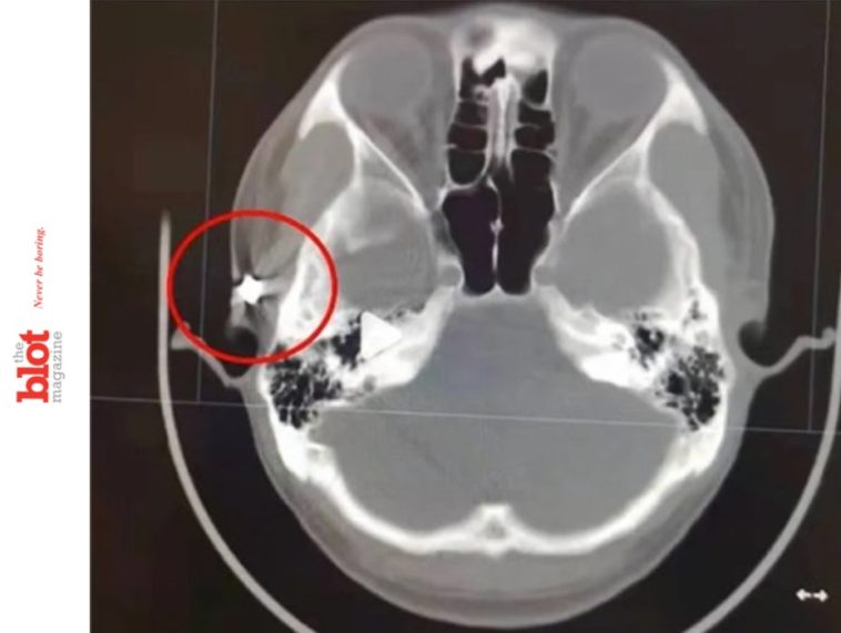 20 Years With Air Gun Pellet in Head Caused Man’s Chronic Headaches