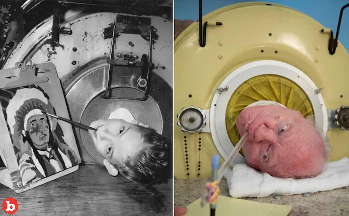 After Living 70 Years In An Iron Lung, Polio Survivor Dies of Covid